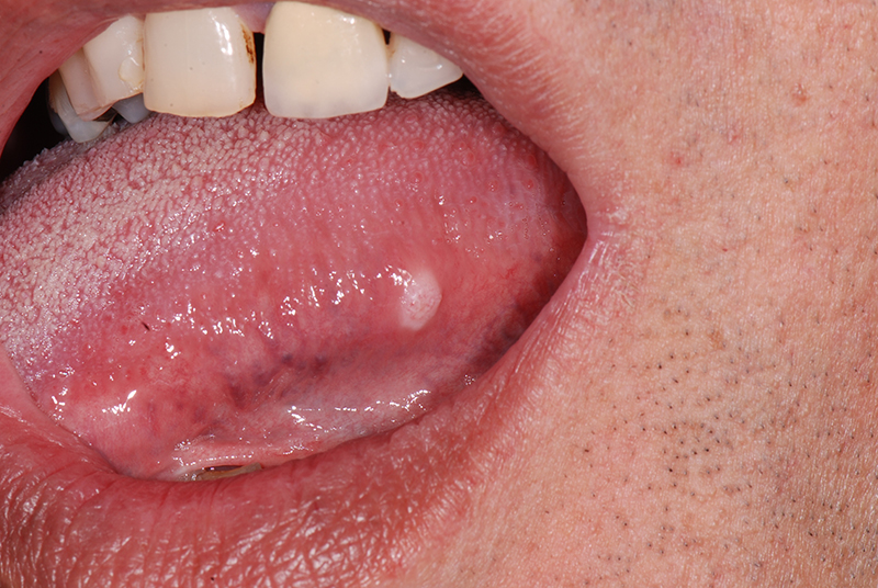 Ung thư lưỡi giai đoạn khởi phát xuất hiện các mảng trắng ở lưỡi